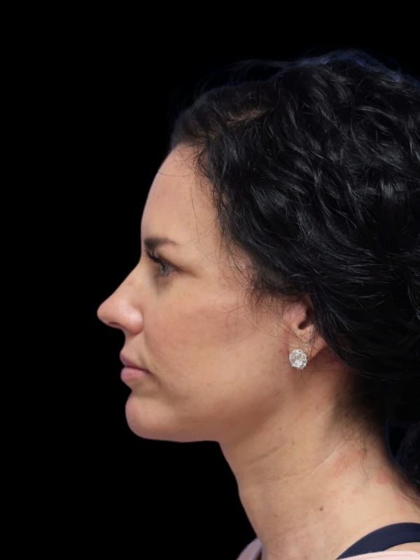 Deep Plane Facelift Gallery Before & After