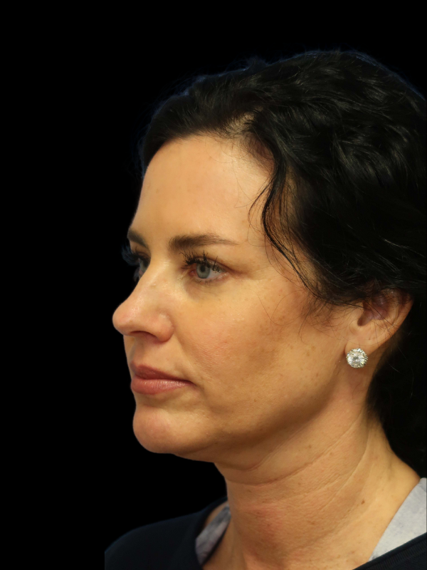 Deep Plane Facelift Gallery Before & After