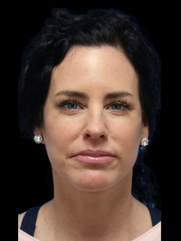 Deep Plane Facelift Gallery Before & After