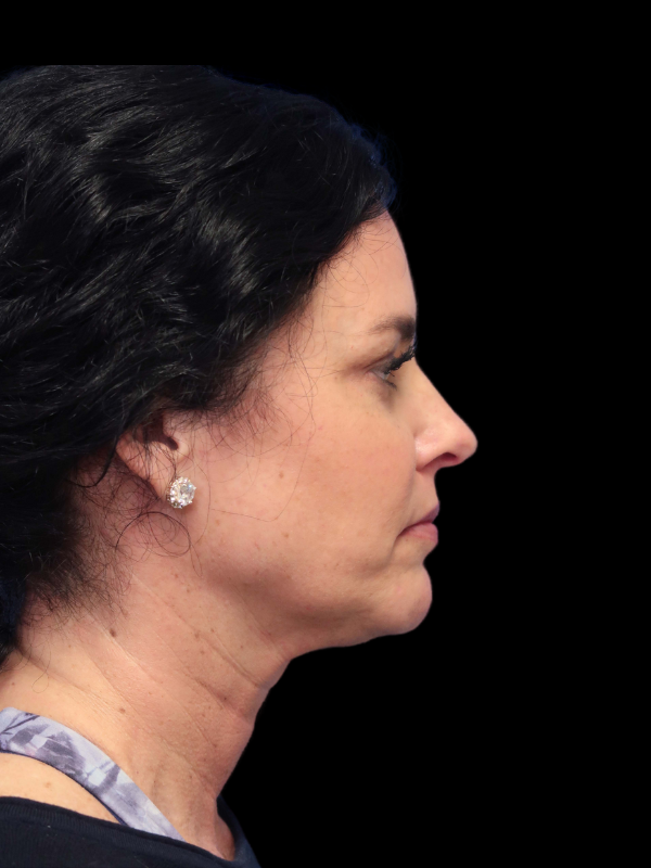 Deep Plane Facelift Gallery Before & After