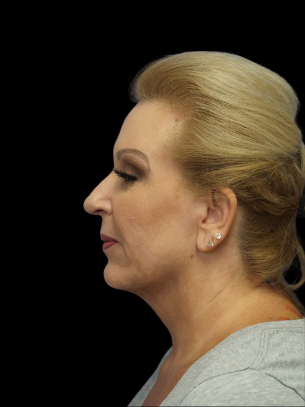 Deep Plane Facelift Gallery Before & After