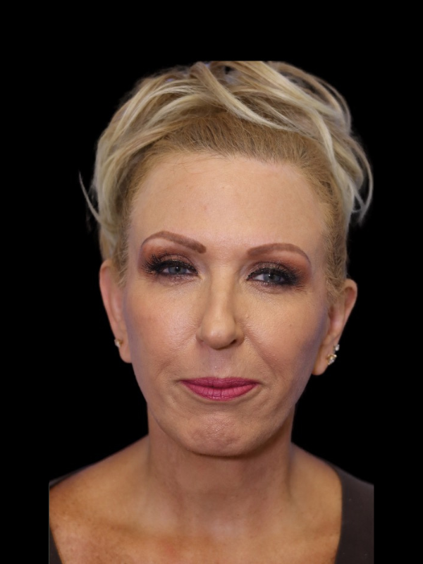 Deep Plane Facelift Gallery Before & After