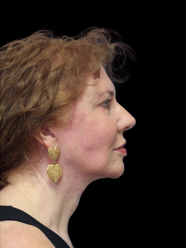 Deep Plane Facelift Gallery Before & After