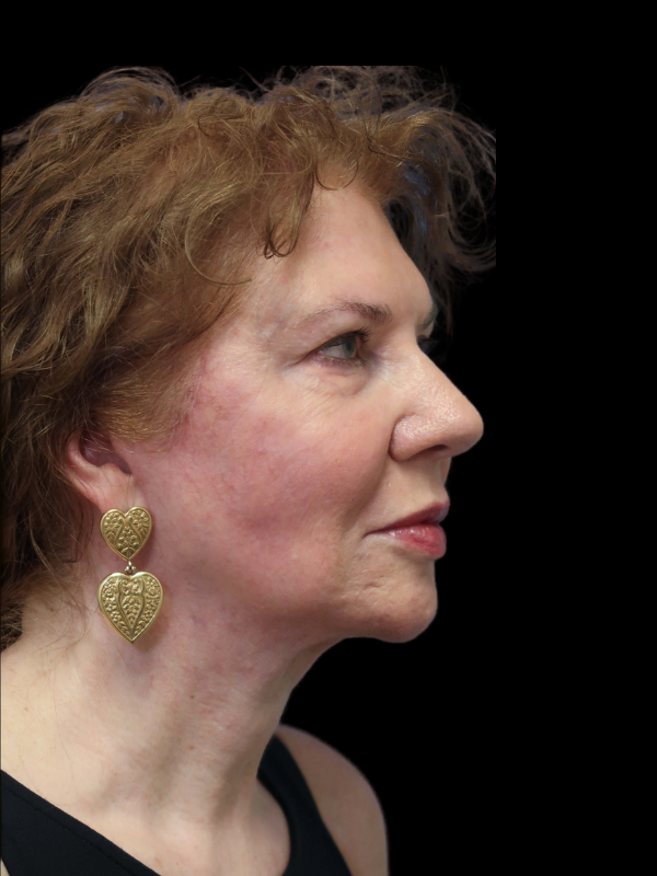 Deep Plane Facelift Gallery Before & After