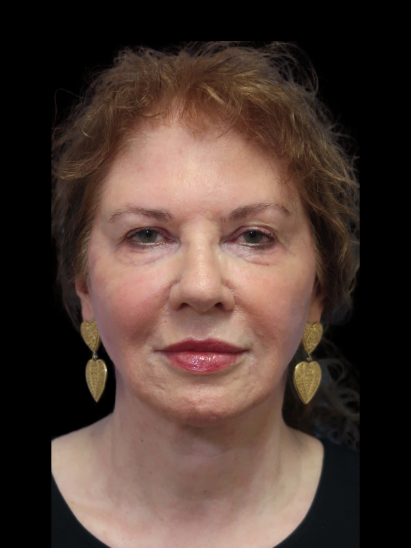 Deep Plane Facelift Gallery Before & After