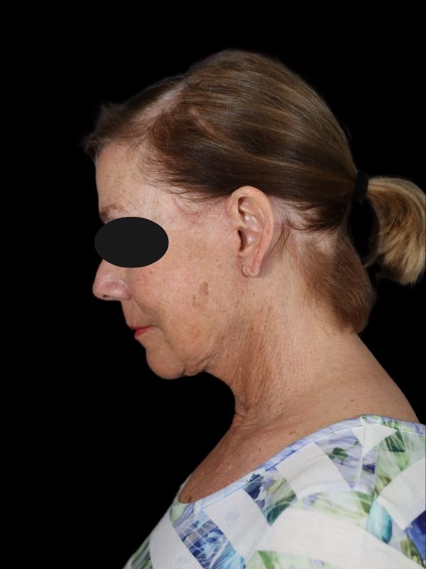 Deep Plane Facelift Gallery Before & After