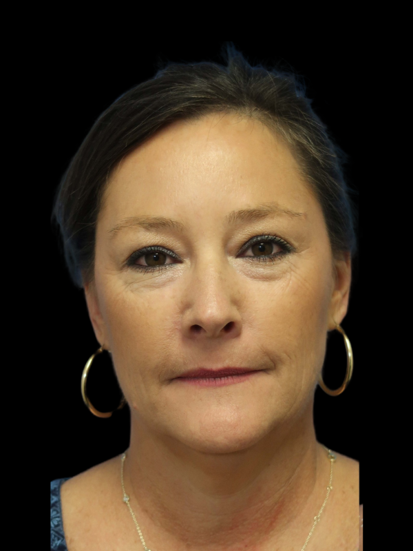 Deep Plane Facelift Gallery Before & After