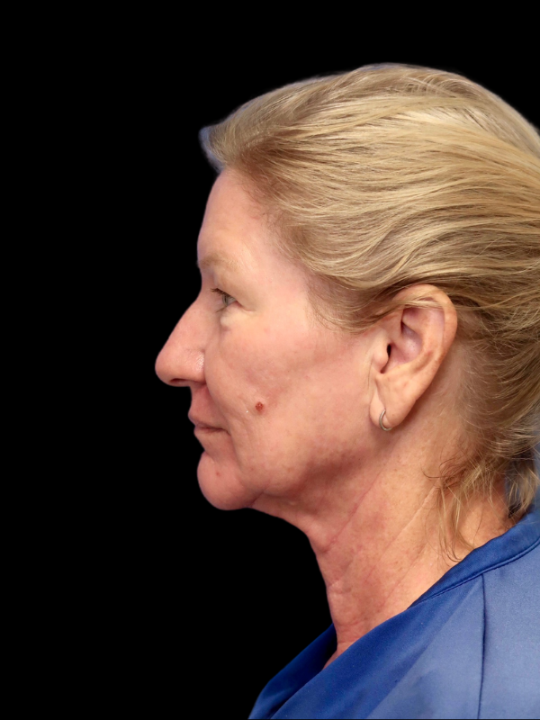 Deep Plane Facelift Gallery Before & After