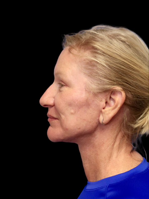 Deep Plane Facelift Gallery Before & After