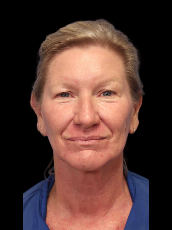 Deep Plane Facelift Gallery Before & After