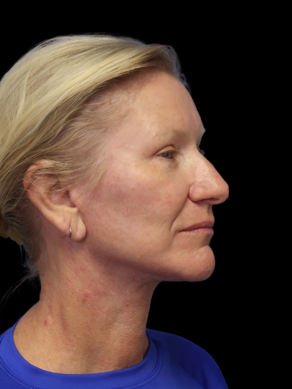 Deep Plane Facelift Gallery Before & After