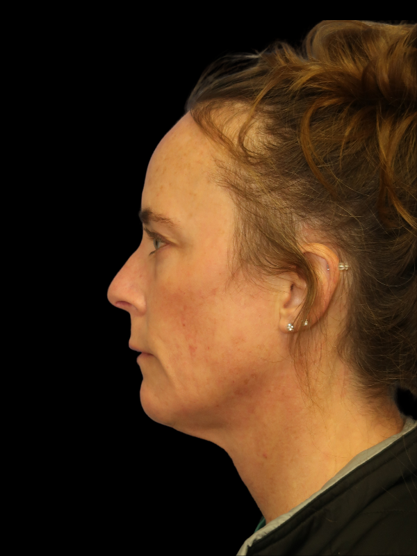 Deep Plane Facelift Gallery Before & After