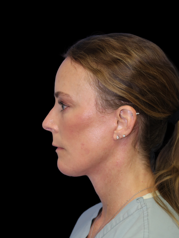 Deep Plane Facelift Gallery Before & After