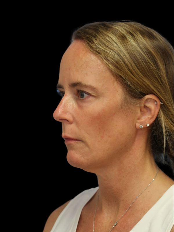 Deep Plane Facelift Gallery Before & After