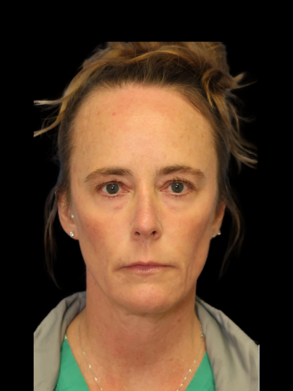 Deep Plane Facelift Gallery Before & After