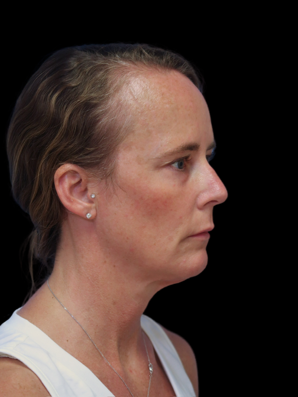 Deep Plane Facelift Gallery Before & After