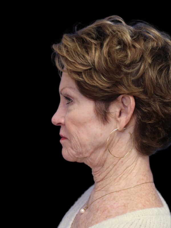 Deep Plane Facelift Gallery Before & After