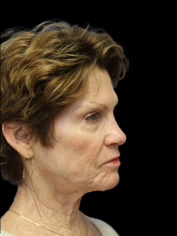 Deep Plane Facelift Gallery Before & After