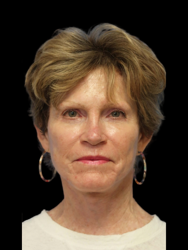 Deep Plane Facelift Gallery Before & After