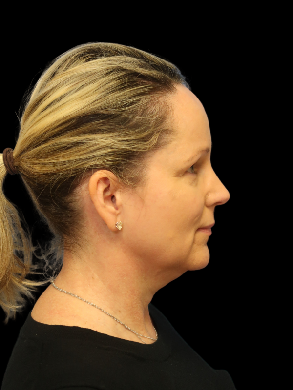 Deep Plane Facelift Gallery Before & After