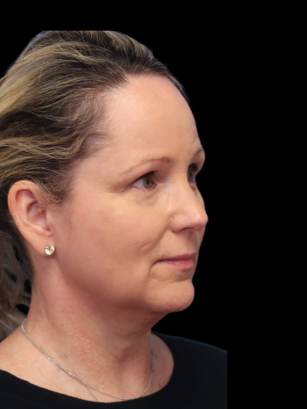 Deep Plane Facelift Gallery Before & After