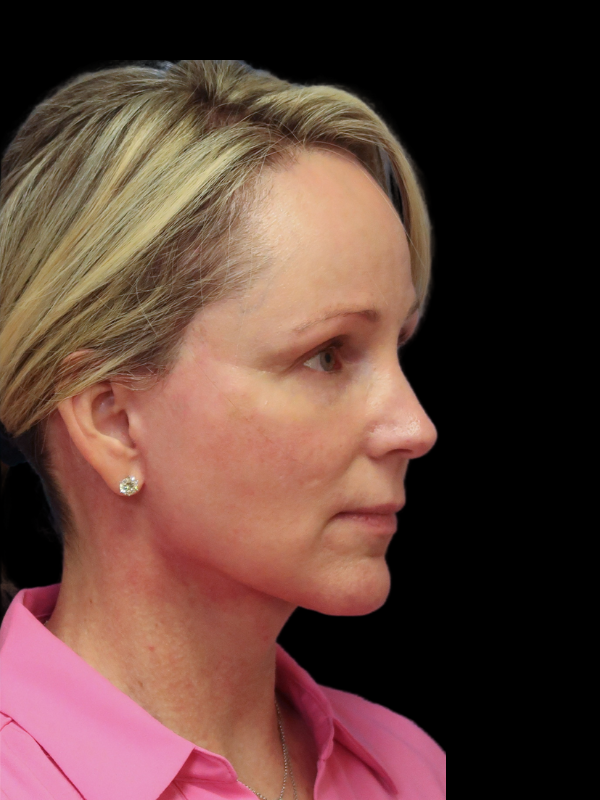 Deep Plane Facelift Gallery Before & After