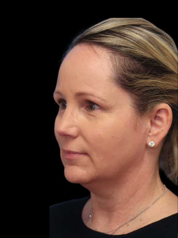 Deep Plane Facelift Gallery Before & After