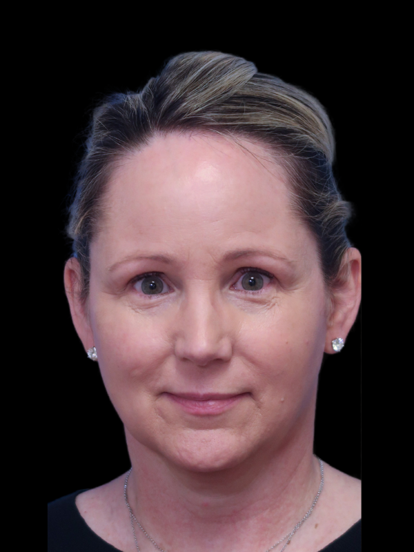 Deep Plane Facelift Gallery Before & After