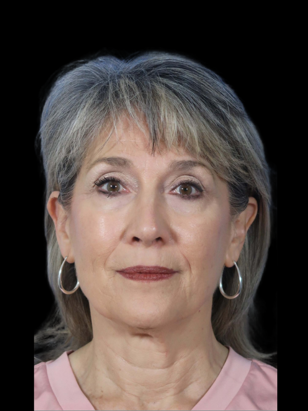 Deep Plane Facelift Gallery Before & After