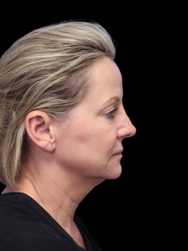 Deep Plane Facelift Gallery Before & After