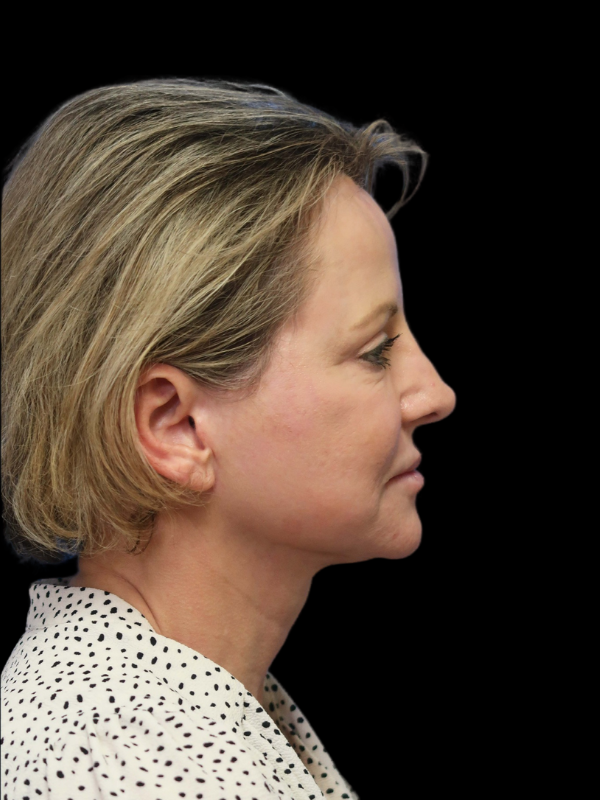 Deep Plane Facelift Gallery Before & After