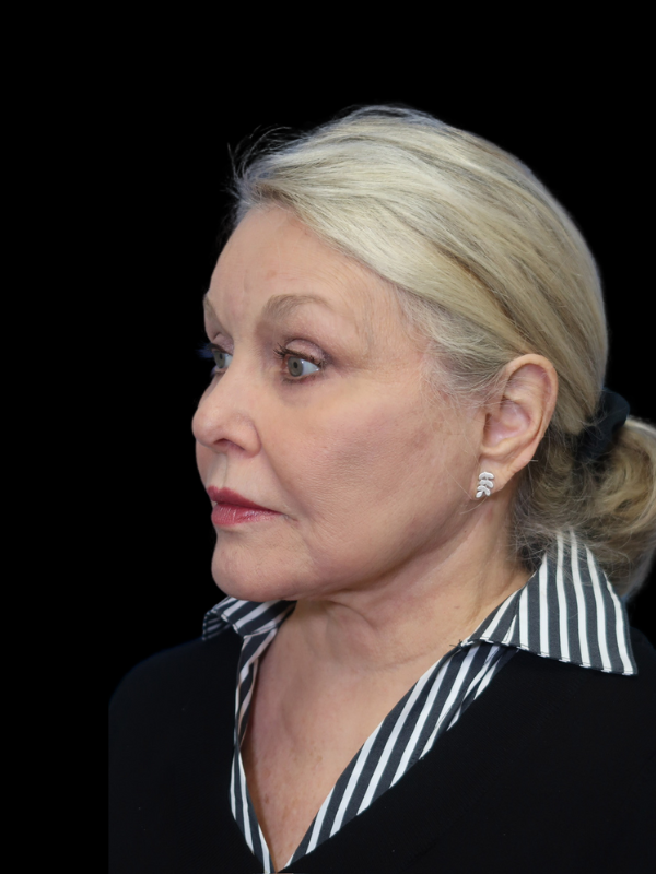 Deep Plane Facelift Gallery Before & After