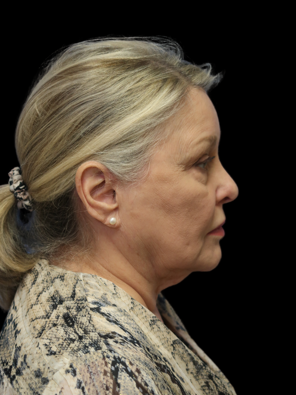 Deep Plane Facelift Gallery Before & After