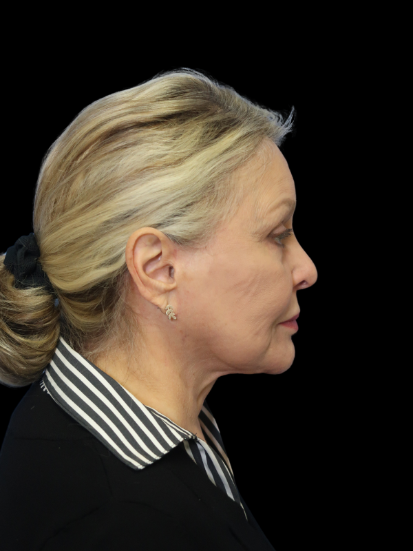 Deep Plane Facelift Gallery Before & After