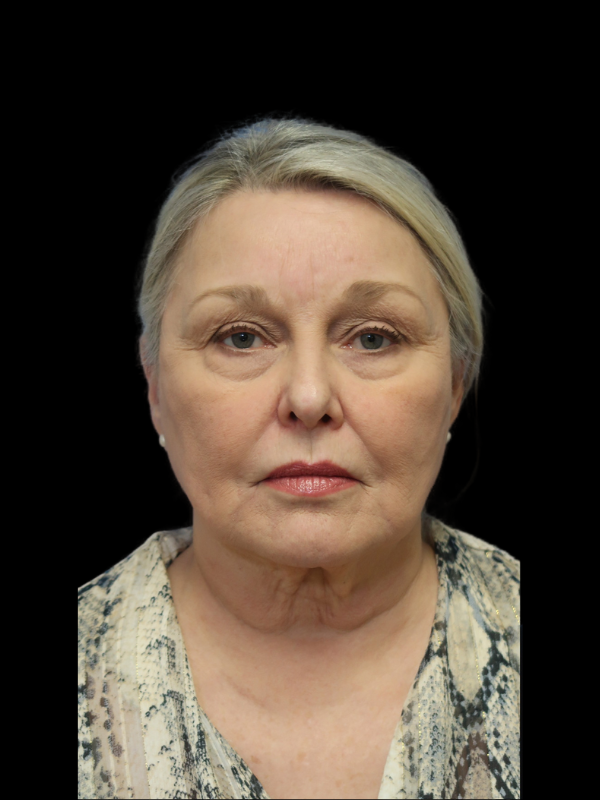 Deep Plane Facelift Gallery Before & After