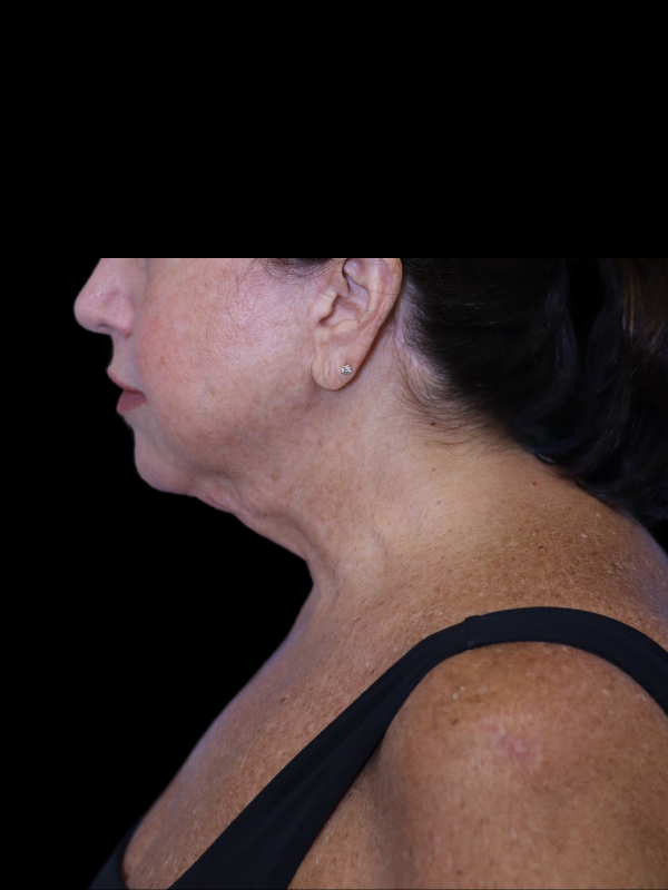 Deep Plane Facelift Gallery Before & After