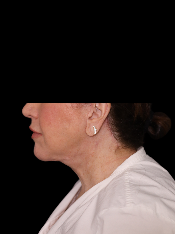 Deep Plane Facelift Gallery Before & After