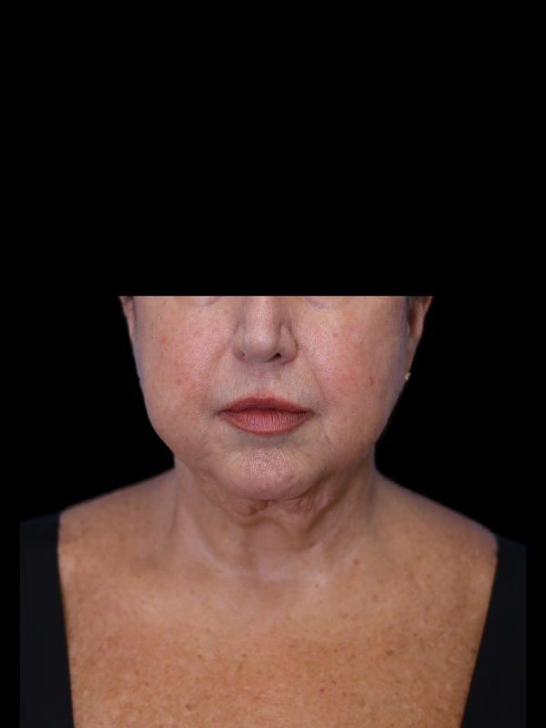 Deep Plane Facelift Gallery Before & After