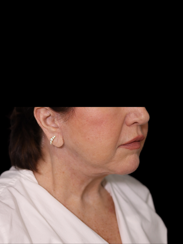 Deep Plane Facelift Gallery Before & After