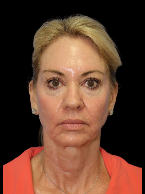 Deep Plane Facelift Gallery Before & After
