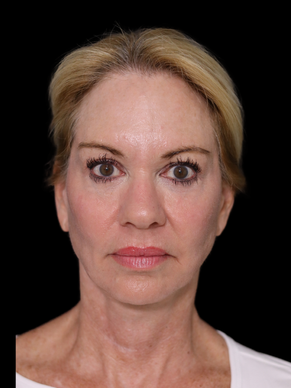 Deep Plane Facelift Gallery Before & After