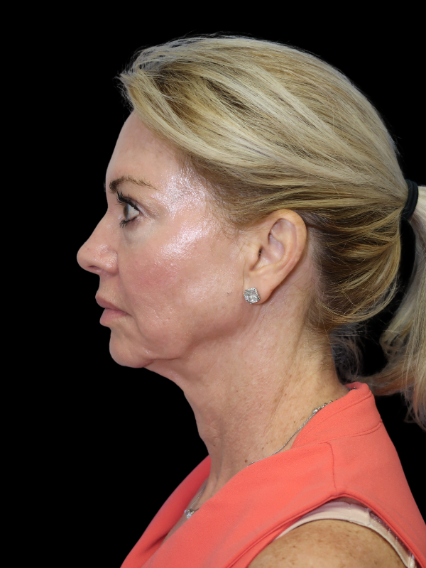 Deep Plane Facelift Gallery Before & After