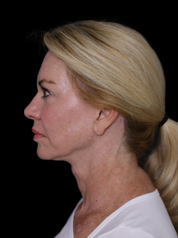 Deep Plane Facelift Gallery Before & After