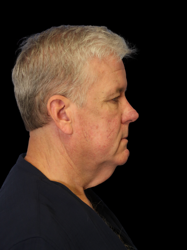 Deep Plane Facelift Gallery Before & After