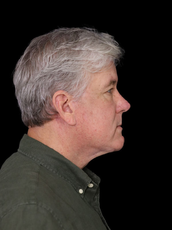 Deep Plane Facelift Gallery Before & After