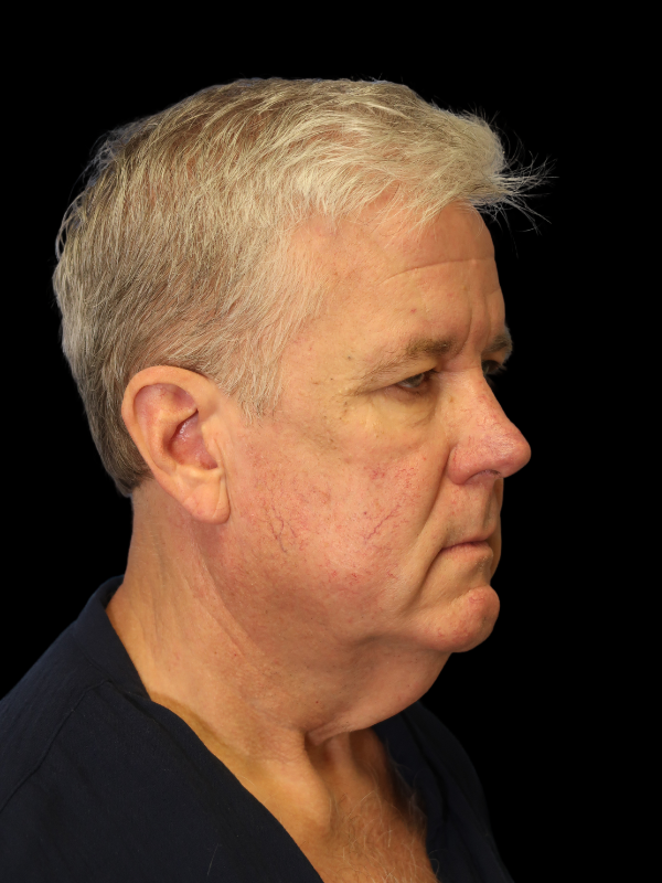 Deep Plane Facelift Gallery Before & After