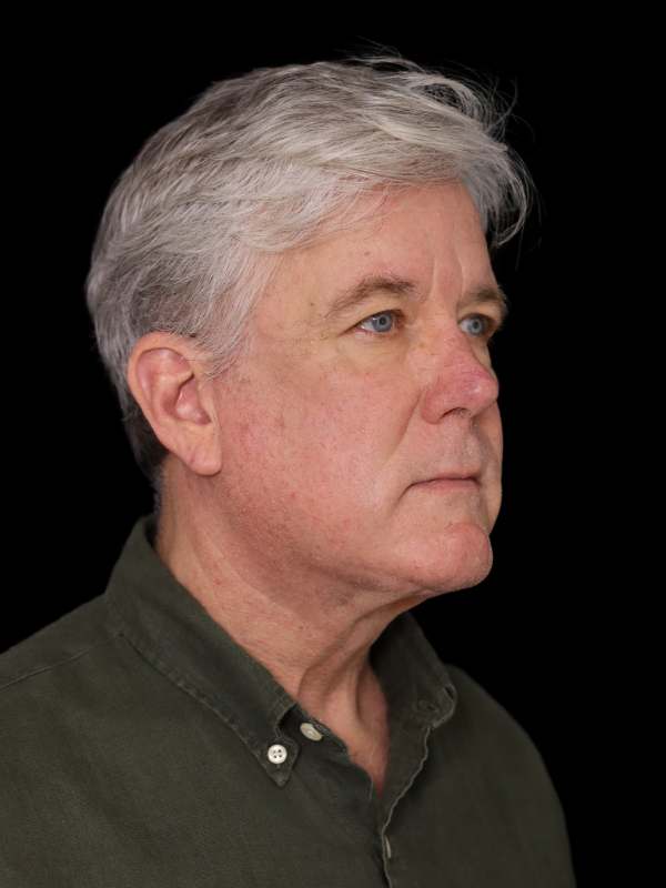 Deep Plane Facelift Gallery Before & After