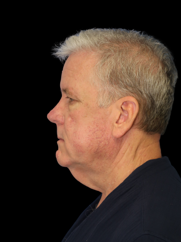 Deep Plane Facelift Gallery Before & After