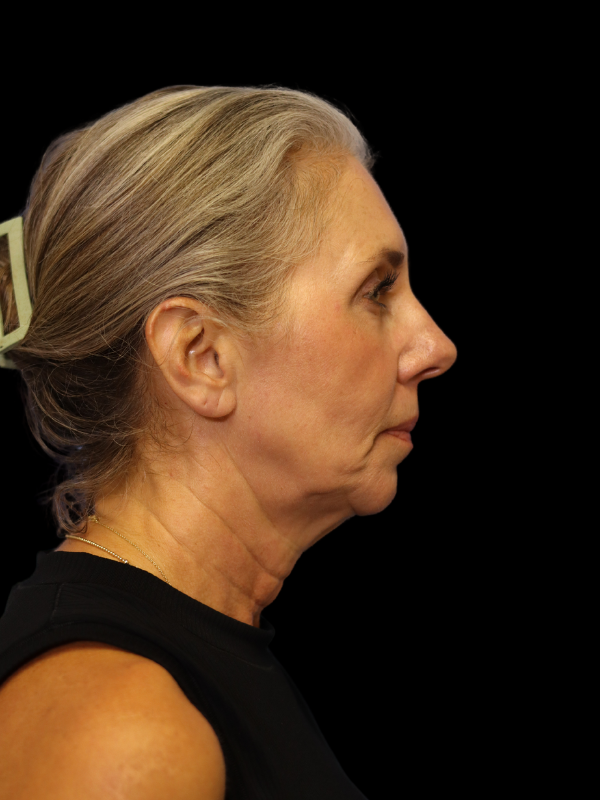 Deep Plane Facelift Gallery Before & After