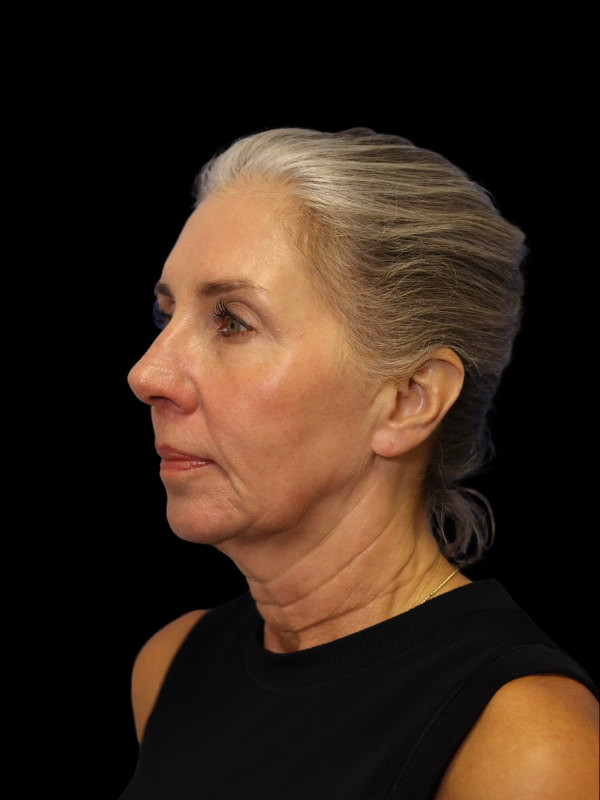 Deep Plane Facelift Gallery Before & After